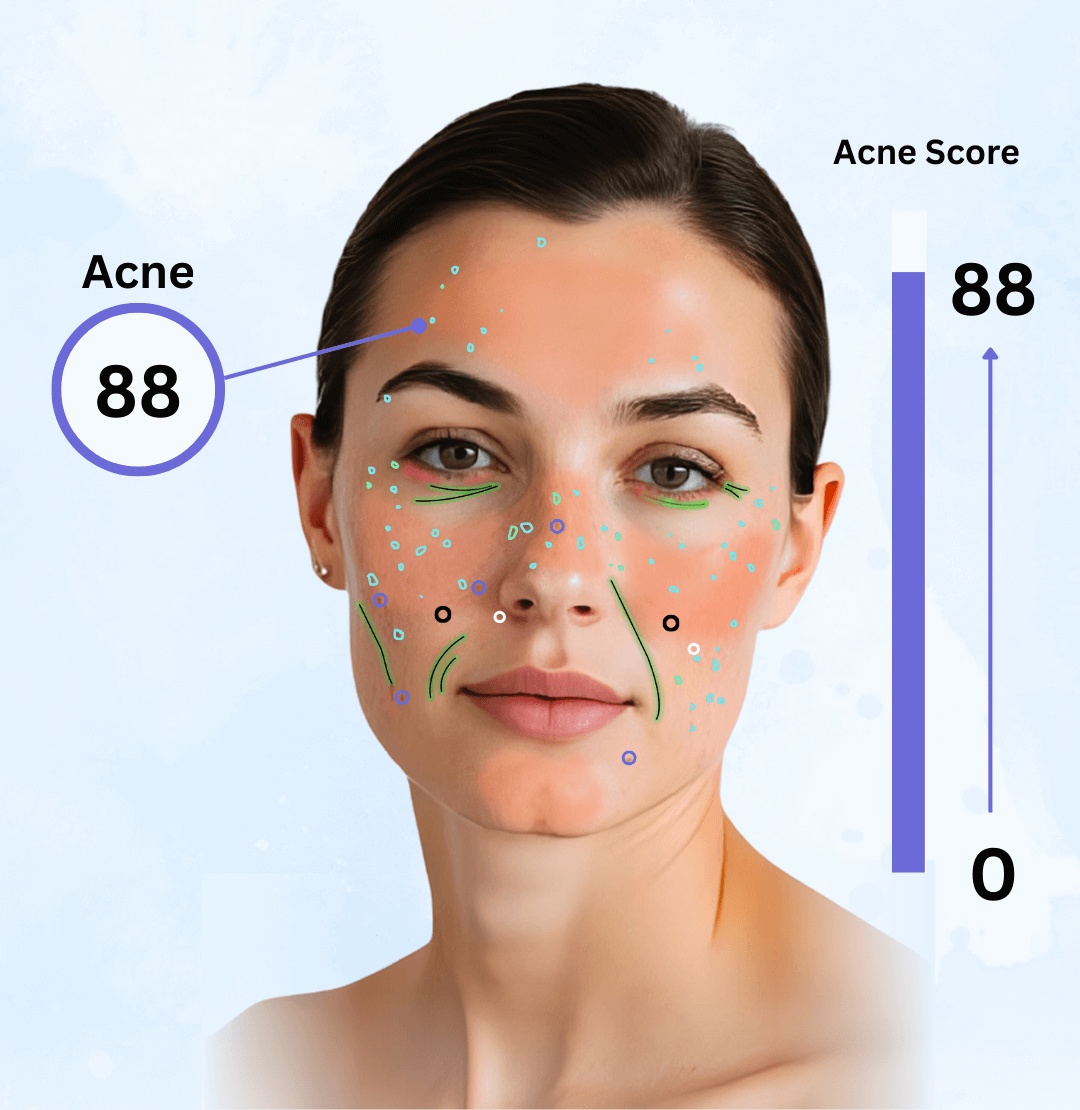 Acne Severity Score