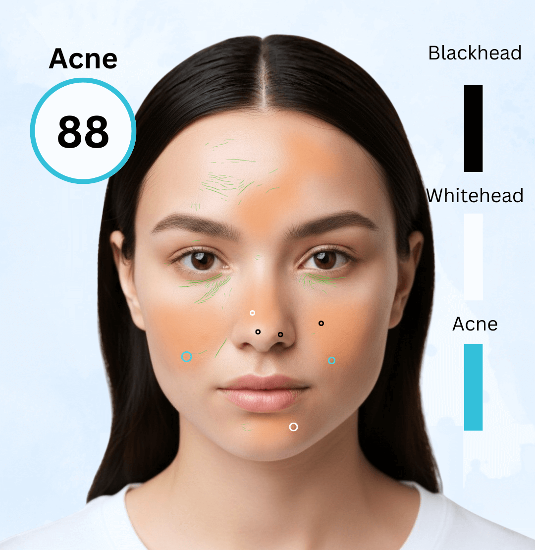 acne-scanner