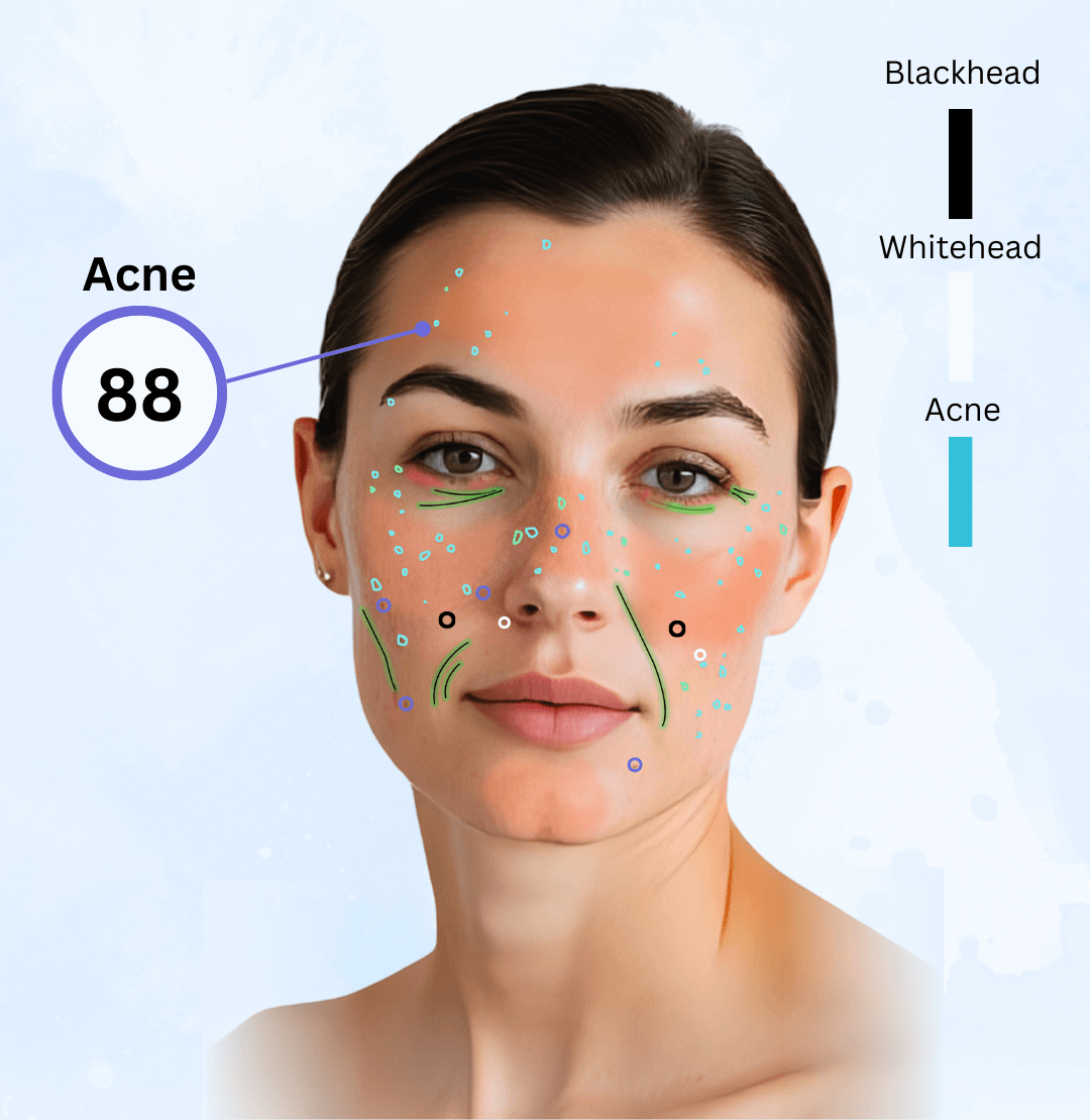 acne-scanner